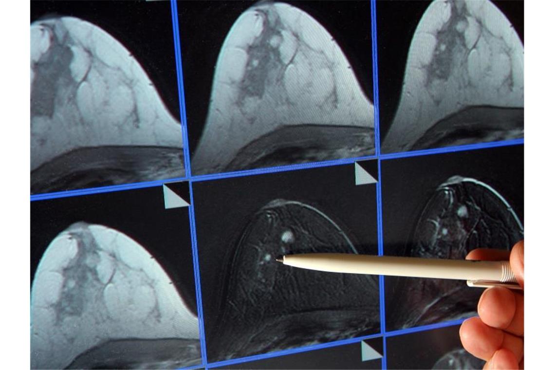 Krebsvorsorge - höhere Sterblichkeit wegen Corona? Auf der Bildschirmdarstellung einer Magnetresonanz-(MR)-Mammographie ist ein winziger Tumor in der Brust einer Patientin zu sehen. Foto: Jan-Peter Kasper/dpa-Zentralbild/dpa