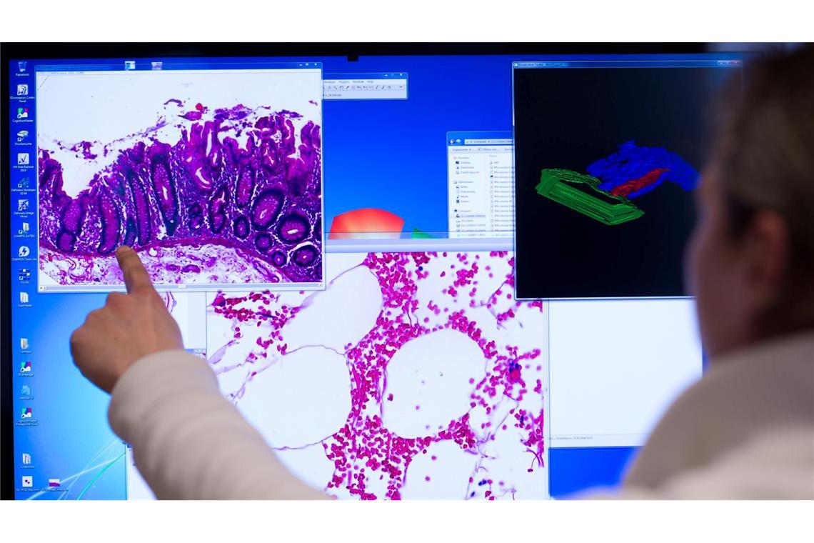 Darmkrebs ist die dritthäufigste Tumorerkrankung in Deutschland. (Archivbild)