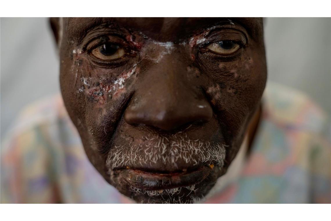 Ein 90 Jahre alter Mann, der an Mpox erkrankt ist, wartet auf eine Behandlung in einer Klinik im Kongo.