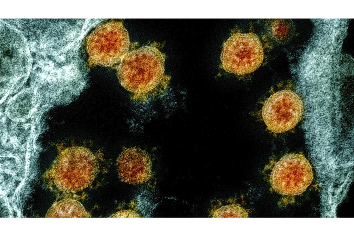 Farblich bearbeitete Partikel des Coronavirus SARS-CoV-2. Forscher stellten jetzt einen besonders extremen Fall einer Corona-Infektion vor.